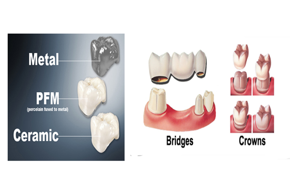 Crowns & Bridges