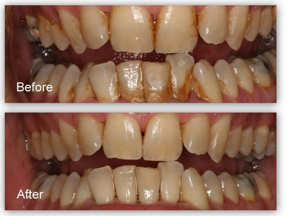 Dental Scaling & Polishing