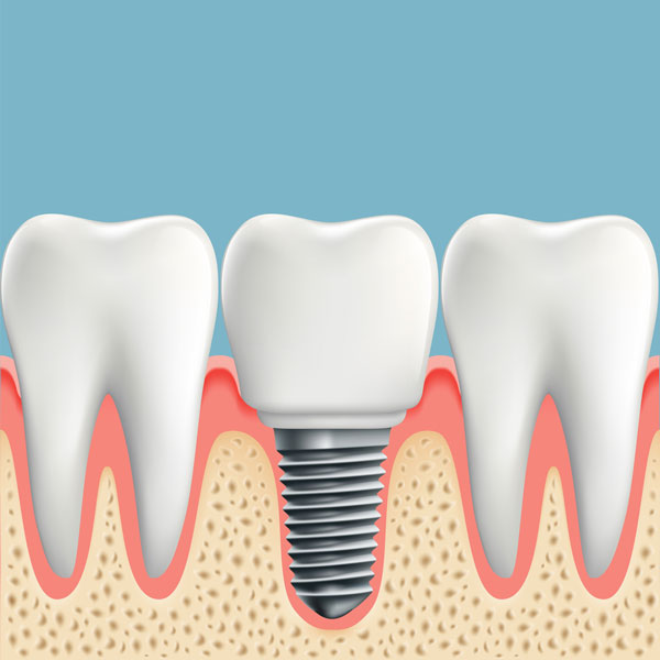 Dental Implants