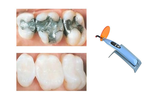 Dental Fillings