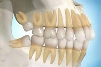 Wisdom tooth extraction